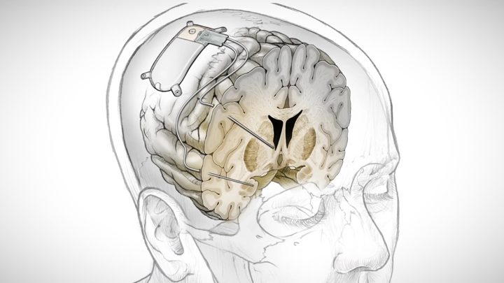 Незамедлительный эффект: мозговой имплантат справился с тяжёлой депрессией