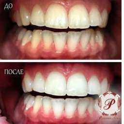 Отбеливание зубов в Ростове-на-Дону