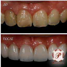 Успей стать обладателем белоснежной улыбки до первого снега!